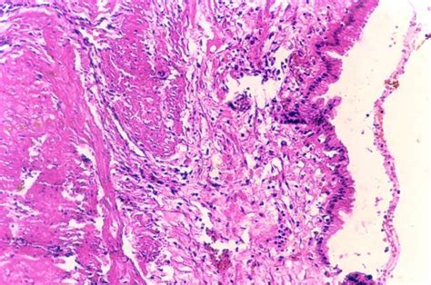 patologia hiperplazie pseudoepiteliomatoasă conturează glomusul